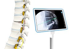 Computer Navigated Thoracic Spine Surgery