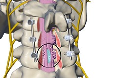 Dural Repair or Other Spinal Cord Repair